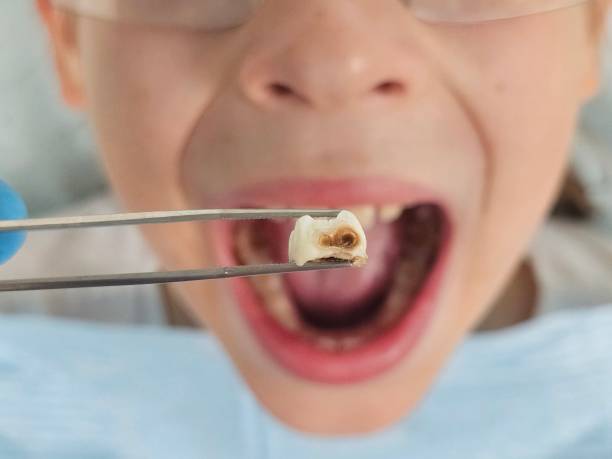 Best Urgent Tooth Repair  in Wellsville, KS